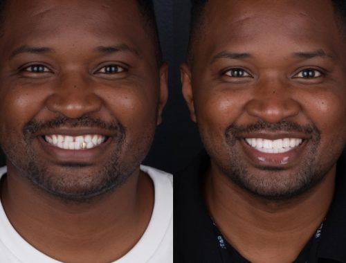 JJS Dentistry Tebogo Pin-Pin Smile Journey Before and After